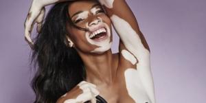 Winnie Harlow Tatilde!